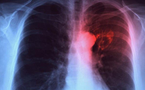 Casi dos mil pacientes con tuberculosis reciben tratamiento en RD