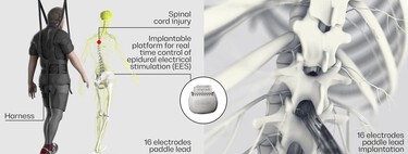 Un "puente digital" entre cerebro y cuerpo: la tecnología pionera para recuperar a pacientes con parálisis