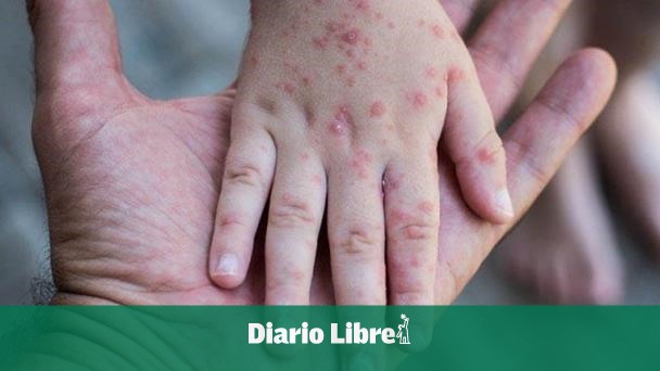 OMS revela otra posible vía de contagio de la viruela símica